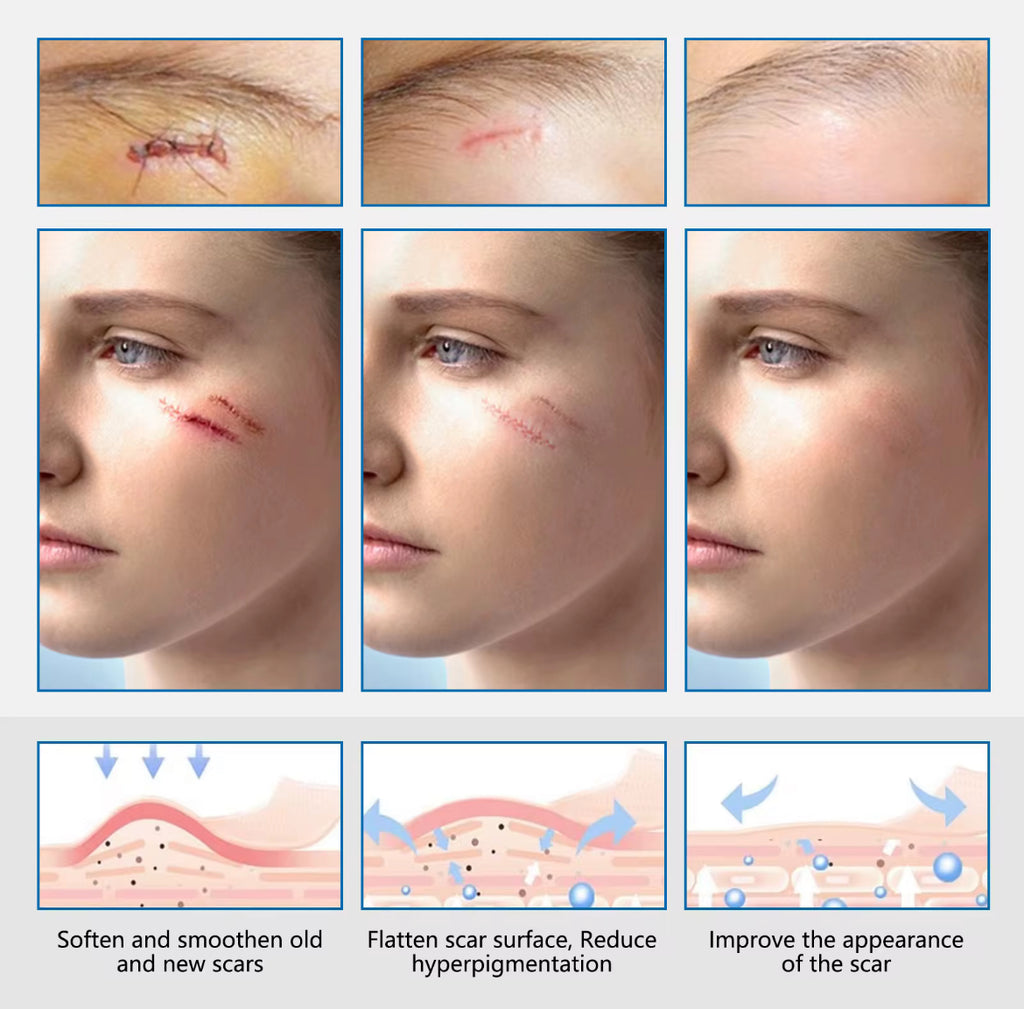 Clear Silicone Scar Sheets