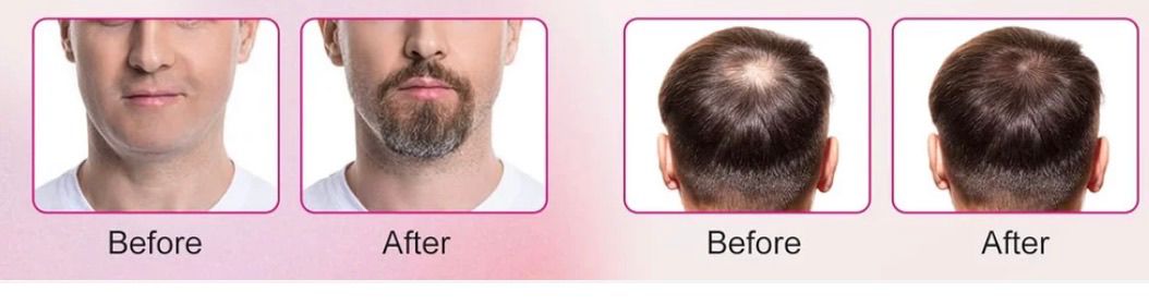 Derma Roller Scalp Massager